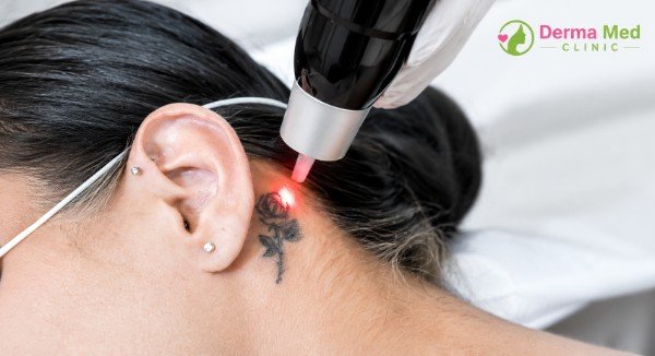 Tattoo removal laser in Chhatarpur
