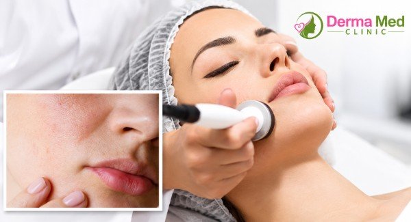 Laser Treatment in chhatarpur