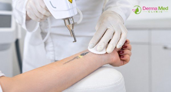 Tattoo removal laser in Chhatarpur
